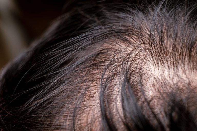 Trockene Kopfhaut Haarausfall – Zusammenhang & Behandlung